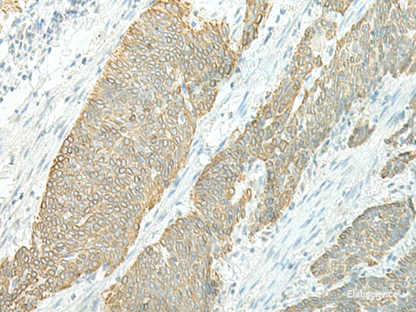 Immunohistochemistry of paraffin-embedded Human esophagus cancer tissue  using ETAA1 Polyclonal Antibody at dilution of 1:25(×200)