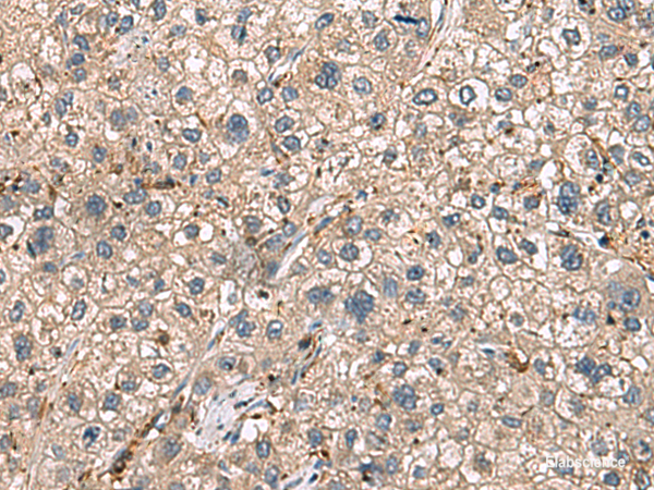 Immunohistochemistry of paraffin-embedded Human liver cancer tissue  using HLA-DRA Polyclonal Antibody at dilution of 1:30(×200)