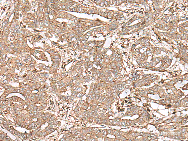 Immunohistochemistry of paraffin-embedded Human liver cancer tissue  using FAAP24 Polyclonal Antibody at dilution of 1:30(×200)
