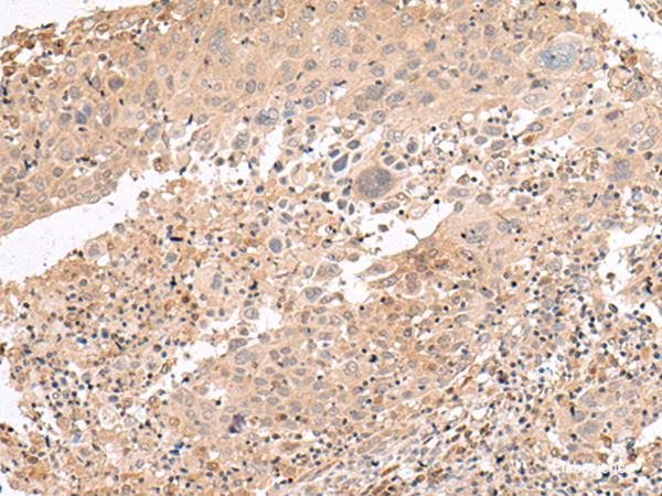Immunohistochemistry of paraffin-embedded Human cervical cancer tissue  using PATJ Polyclonal Antibody at dilution of 1:45(×200)