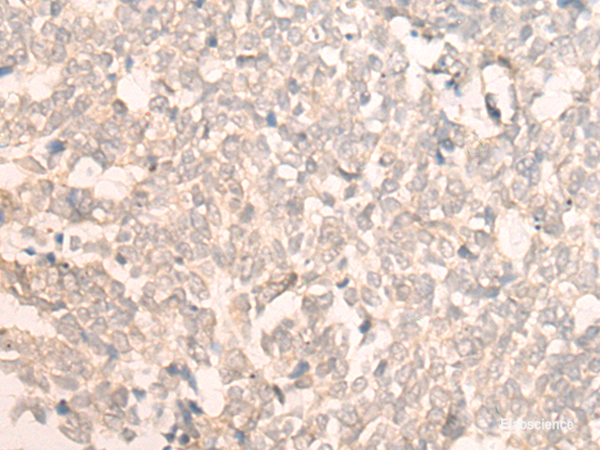 Immunohistochemistry of paraffin-embedded Human lung cancer tissue  using FAN1 Polyclonal Antibody at dilution of 1:30(×200)