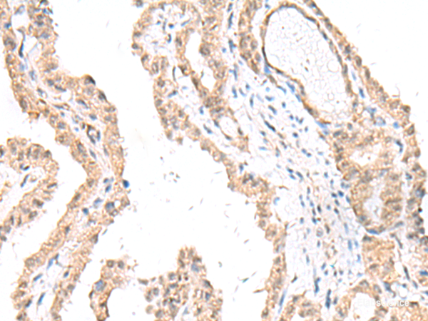 Immunohistochemistry of paraffin-embedded Human thyroid cancer tissue  using FANCE Polyclonal Antibody at dilution of 1:50(×200)