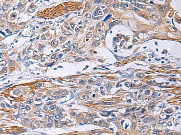 Immunohistochemistry of paraffin-embedded Human esophagus cancer tissue  using FBXO45 Polyclonal Antibody at dilution of 1:40(×200)