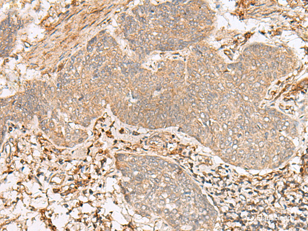 Immunohistochemistry of paraffin-embedded Human esophagus cancer tissue  using FBXW8 Polyclonal Antibody at dilution of 1:65(×200)