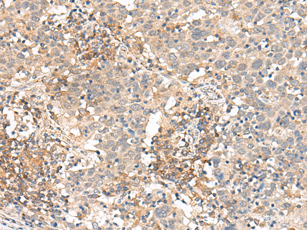 Immunohistochemistry of paraffin-embedded Human cervical cancer tissue  using SLC40A1 Polyclonal Antibody at dilution of 1:90(×200)