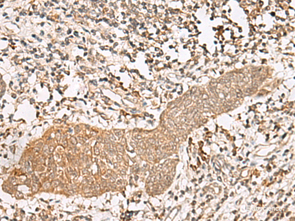 Immunohistochemistry of paraffin-embedded Human esophagus cancer tissue  using FGF13 Polyclonal Antibody at dilution of 1:45(×200)