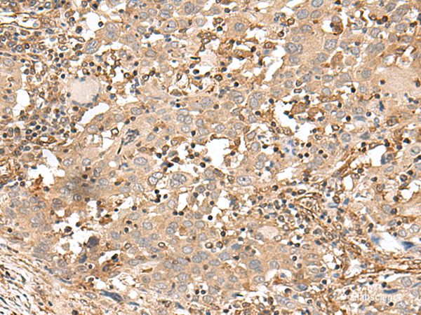 Immunohistochemistry of paraffin-embedded Human cervical cancer tissue  using FSTL5 Polyclonal Antibody at dilution of 1:50(×200)