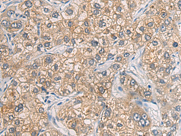 Immunohistochemistry of paraffin-embedded Human liver cancer tissue  using GAB4 Polyclonal Antibody at dilution of 1:60(×200)
