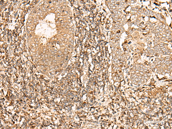 Immunohistochemistry of paraffin-embedded Human esophagus cancer tissue  using GALR2 Polyclonal Antibody at dilution of 1:40(×200)