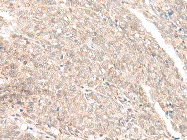 Immunohistochemistry of paraffin-embedded Human ovarian cancer tissue  using GANC Polyclonal Antibody at dilution of 1:45(×200)