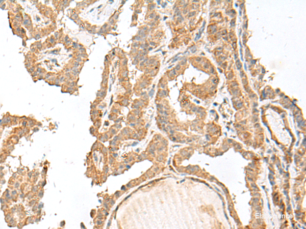 Immunohistochemistry of paraffin-embedded Human thyroid cancer tissue  using GART Polyclonal Antibody at dilution of 1:30(×200)