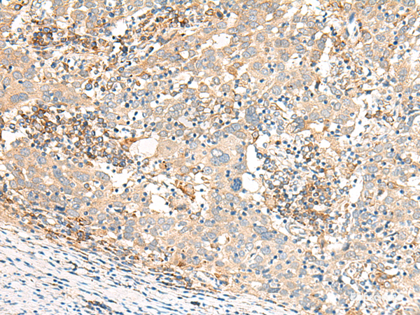 Immunohistochemistry of paraffin-embedded Human cervical cancer tissue  using GBP4 Polyclonal Antibody at dilution of 1:30(×200)