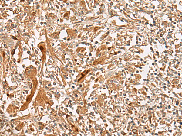 Immunohistochemistry of paraffin-embedded Human liver cancer tissue  using GCC2 Polyclonal Antibody at dilution of 1:45(×200)