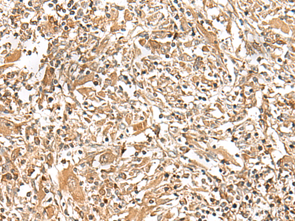 Immunohistochemistry of paraffin-embedded Human liver cancer tissue  using GEMIN4 Polyclonal Antibody at dilution of 1:30(×200)