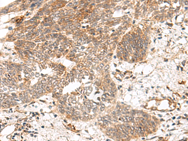 Immunohistochemistry of paraffin-embedded Human esophagus cancer tissue  using GRASP Polyclonal Antibody at dilution of 1:150(×200)