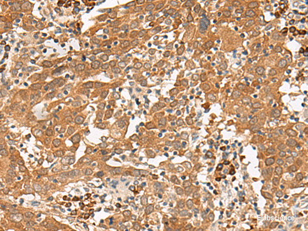 Immunohistochemistry of paraffin-embedded Human cervical cancer tissue  using GFI1 Polyclonal Antibody at dilution of 1:100(×200)
