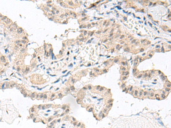 Immunohistochemistry of paraffin-embedded Human thyroid cancer tissue  using GFI1B Polyclonal Antibody at dilution of 1:80(×200)
