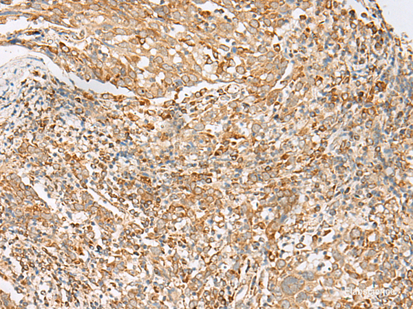 Immunohistochemistry of paraffin-embedded Human cervical cancer tissue  using MBOAT4 Polyclonal Antibody at dilution of 1:30(×200)