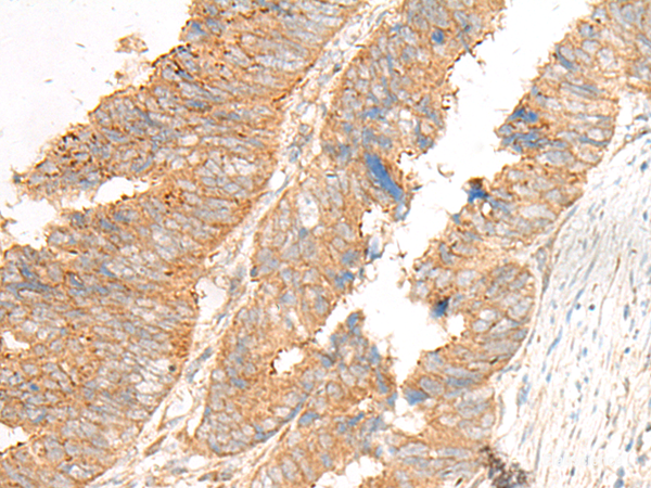 Immunohistochemistry of paraffin-embedded Human colorectal cancer tissue  using GLIS1 Polyclonal Antibody at dilution of 1:50(×200)