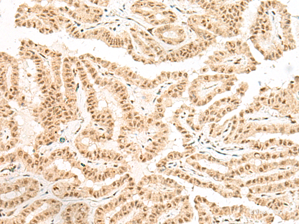 Immunohistochemistry of paraffin-embedded Human thyroid cancer tissue  using BICRA Polyclonal Antibody at dilution of 1:40(×200)