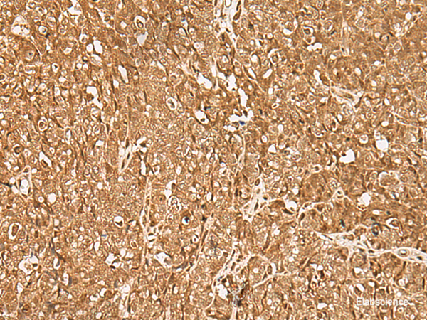 Immunohistochemistry of paraffin-embedded Human ovarian cancer tissue  using GMEB2 Polyclonal Antibody at dilution of 1:35(×200)