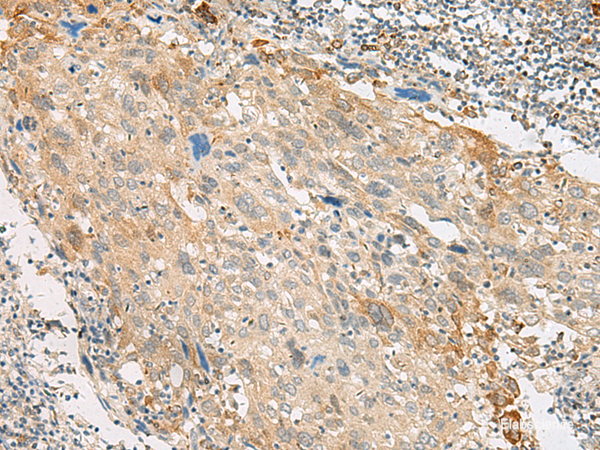 Immunohistochemistry of paraffin-embedded Human cervical cancer tissue  using GPR151 Polyclonal Antibody at dilution of 1:45(×200)