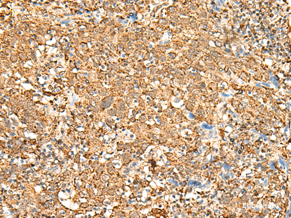 Immunohistochemistry of paraffin-embedded Human cervical cancer tissue  using P2RY14 Polyclonal Antibody at dilution of 1:25(×200)