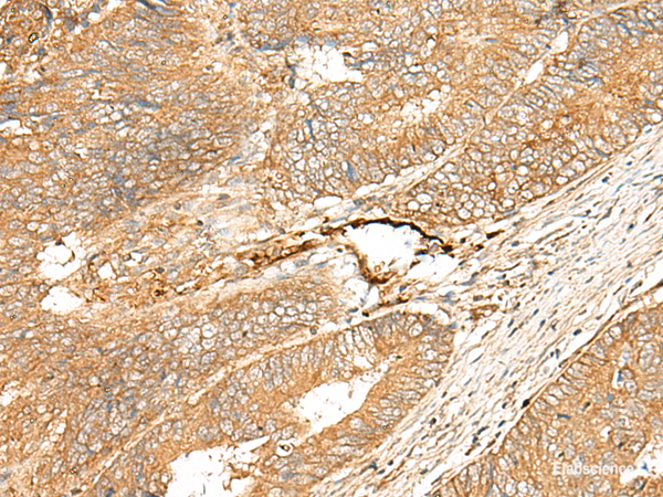 Immunohistochemistry of paraffin-embedded Human colorectal cancer tissue  using ADGRF5 Polyclonal Antibody at dilution of 1:40(×200)