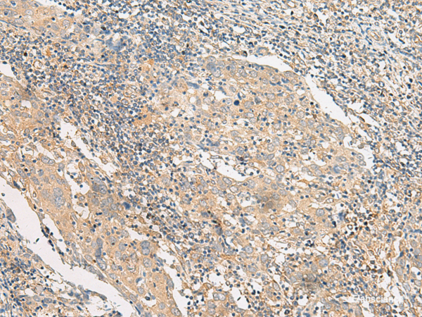 Immunohistochemistry of paraffin-embedded Human cervical cancer tissue  using POLR2L Polyclonal Antibody at dilution of 1:45(×200)