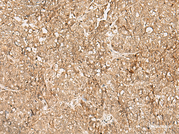 Immunohistochemistry of paraffin-embedded Human ovarian cancer tissue  using SNAPC5 Polyclonal Antibody at dilution of 1:25(×200)