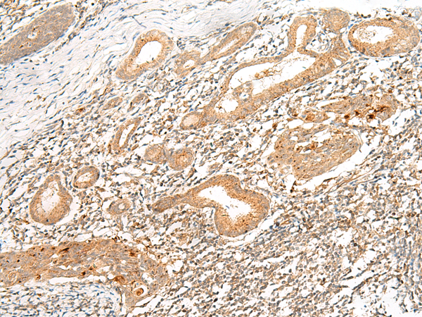 Immunohistochemistry of paraffin-embedded Human esophagus cancer tissue  using HLA-G Polyclonal Antibody at dilution of 1:45(×200)