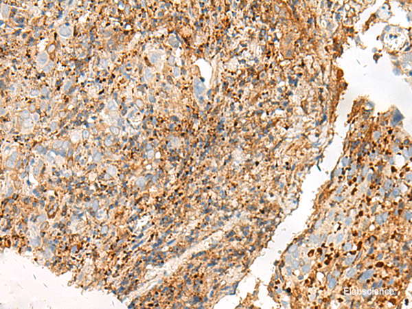 Immunohistochemistry of paraffin-embedded Human cervical cancer tissue  using GPR27 Polyclonal Antibody at dilution of 1:25(×200)