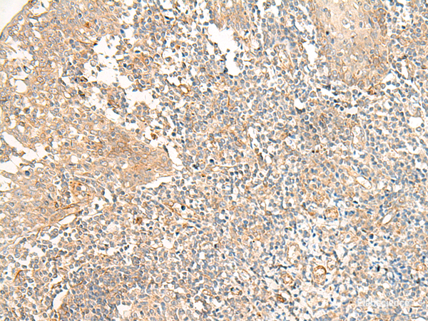 Immunohistochemistry of paraffin-embedded Human tonsil tissue  using PTGDR2 Polyclonal Antibody at dilution of 1:30(×200)