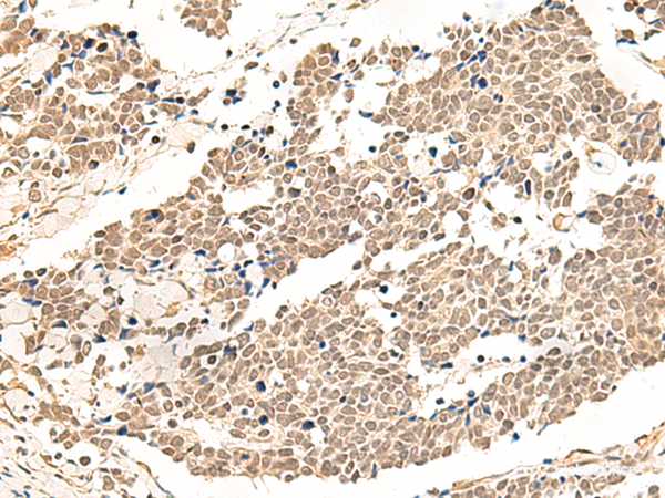 Immunohistochemistry of paraffin-embedded Human lung cancer tissue  using GPR139 Polyclonal Antibody at dilution of 1:50(×200)