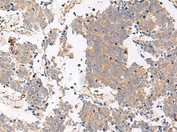 Immunohistochemistry of paraffin-embedded Human lung cancer tissue  using GPR153 Polyclonal Antibody at dilution of 1:40(×200)