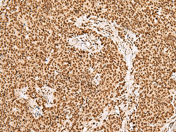 Immunohistochemistry of paraffin-embedded Human ovarian cancer tissue  using GRSF1 Polyclonal Antibody at dilution of 1:30(×200)