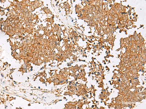 Immunohistochemistry of paraffin-embedded Human lung cancer tissue  using GSTM2 Polyclonal Antibody at dilution of 1:50(×200)