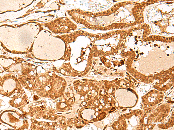Immunohistochemistry of paraffin-embedded Human thyroid cancer tissue  using GTF3C3 Polyclonal Antibody at dilution of 1:30(×200)
