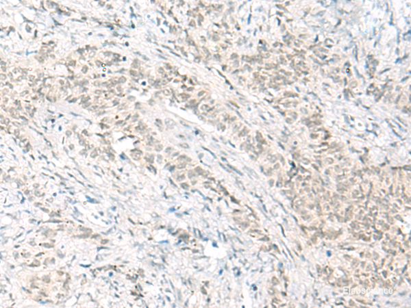 Immunohistochemistry of paraffin-embedded Human ovarian cancer tissue  using HABP4 Polyclonal Antibody at dilution of 1:60(×200)