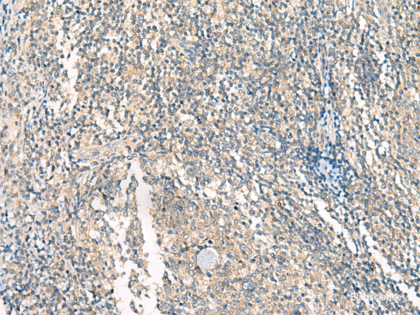 Immunohistochemistry of paraffin-embedded Human tonsil tissue  using HASPIN Polyclonal Antibody at dilution of 1:45(×200)