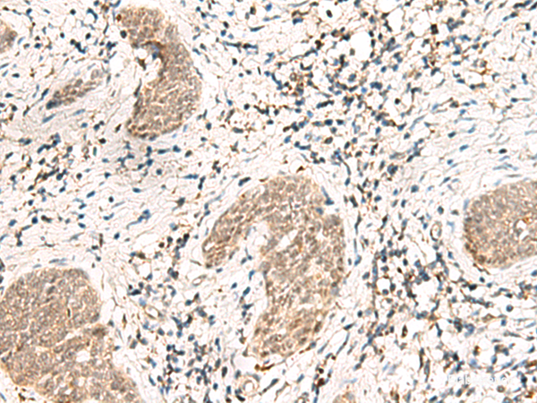 Immunohistochemistry of paraffin-embedded Human esophagus cancer tissue  using SNRPG Polyclonal Antibody at dilution of 1:40(×200)