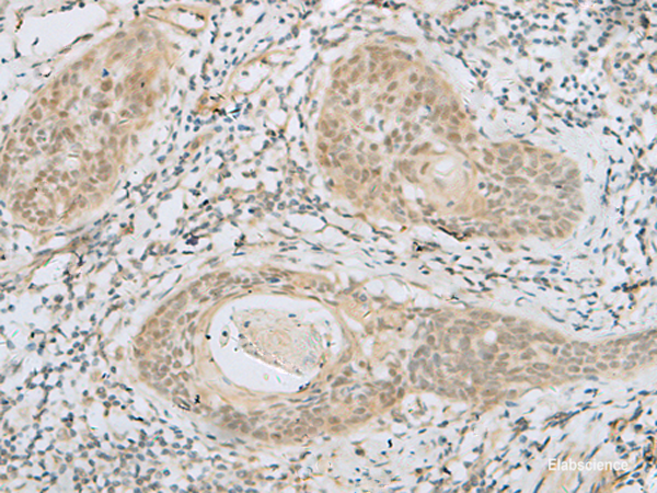 Immunohistochemistry of paraffin-embedded Human esophagus cancer tissue  using HELT Polyclonal Antibody at dilution of 1:40(×200)