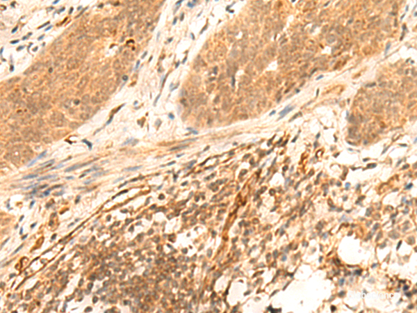 Immunohistochemistry of paraffin-embedded Human esophagus cancer tissue  using HES7 Polyclonal Antibody at dilution of 1:25(×200)