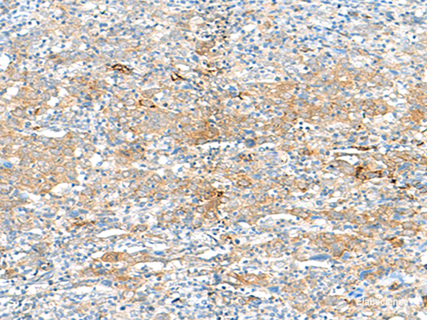 Immunohistochemistry of paraffin-embedded Human cervical cancer tissue  using HLA-DRB3 Polyclonal Antibody at dilution of 1:50(×200)