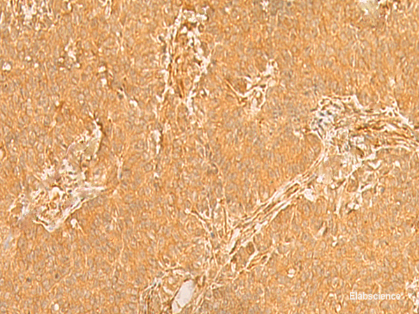 Immunohistochemistry of paraffin-embedded Human breast cancer tissue  using KRT76 Polyclonal Antibody at dilution of 1:50(×200)