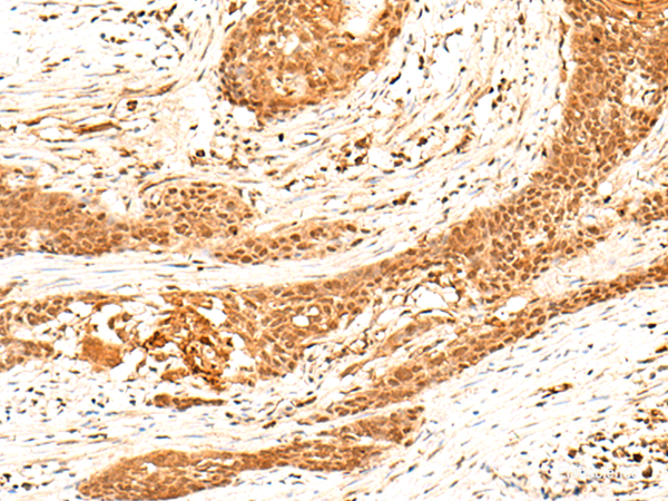 Immunohistochemistry of paraffin-embedded Human esophagus cancer tissue  using HNF4A Polyclonal Antibody at dilution of 1:40(×200)