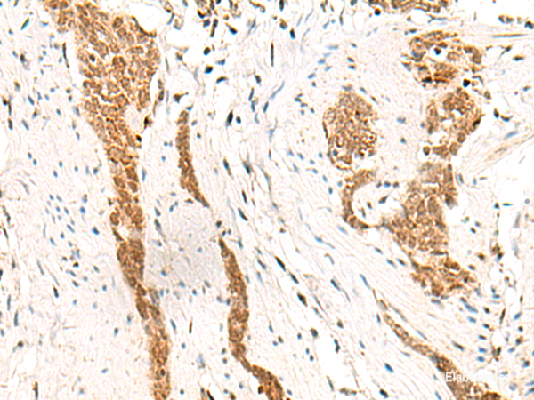 Immunohistochemistry of paraffin-embedded Human esophagus cancer tissue  using HOXC13 Polyclonal Antibody at dilution of 1:60(×200)