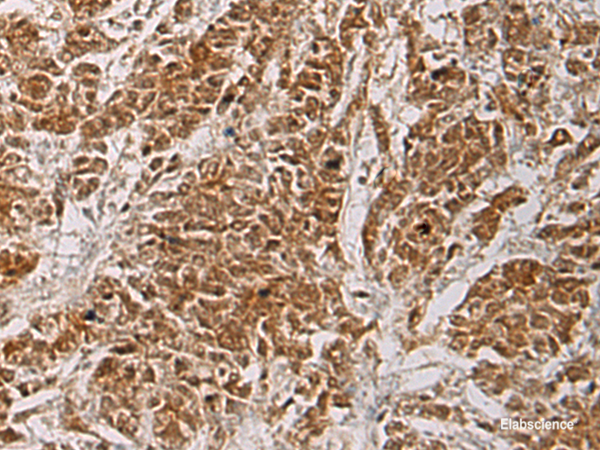 Immunohistochemistry of paraffin-embedded Human colorectal cancer tissue  using HOXC5 Polyclonal Antibody at dilution of 1:55(×200)