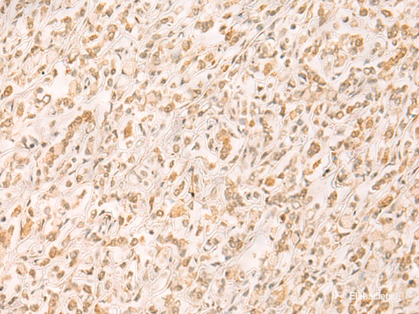Immunohistochemistry of paraffin-embedded Human gastric cancer tissue  using SETD1A Polyclonal Antibody at dilution of 1:25(×200)