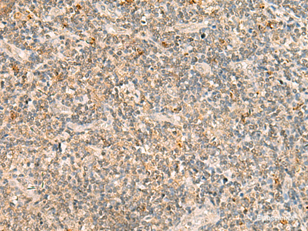 Immunohistochemistry of paraffin-embedded Human tonsil tissue  using TBCK Polyclonal Antibody at dilution of 1:25(×200)